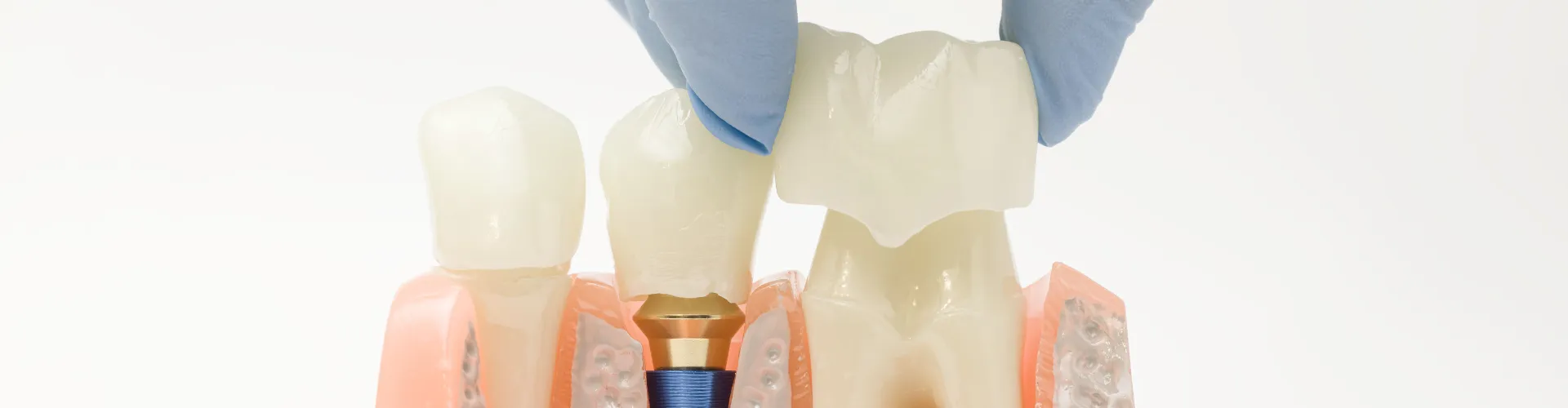 Gloved hand placing dental crown on tooth in model next to dental implant with dental crown.