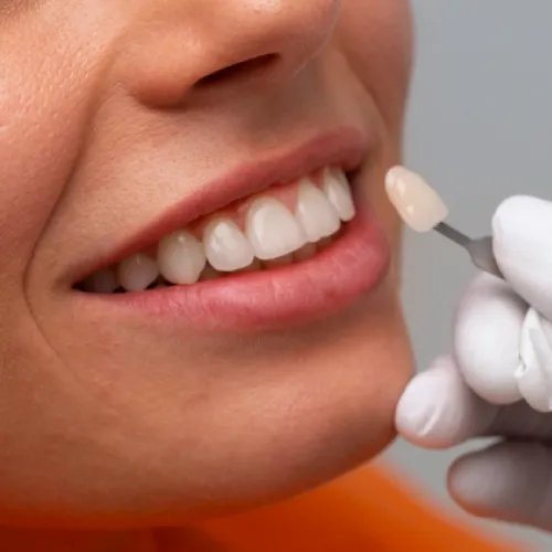 Dentist using a dental shade guide to match veneers or bonding for a patient.