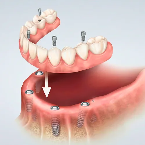 Rendering of a fixed denture being placed onto 4 implants in a lower jaw.