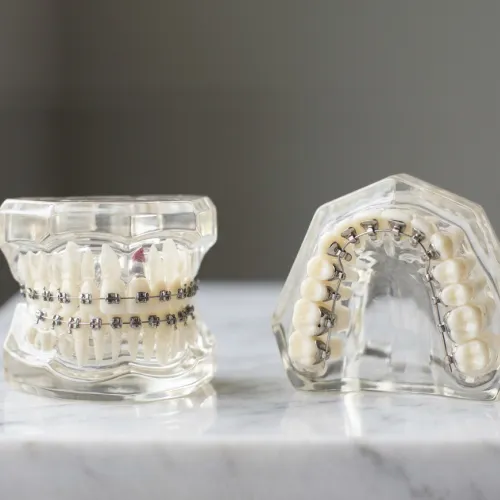 Dental models comparing traditional metal braces and lingual braces for orthodontic treatment.