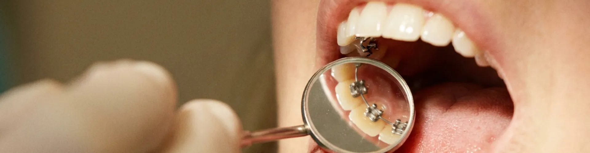 A close-up dental examination showing braces on the back of teeth and a dentist using an intraoral mirror to inspect the patient’s mouth.