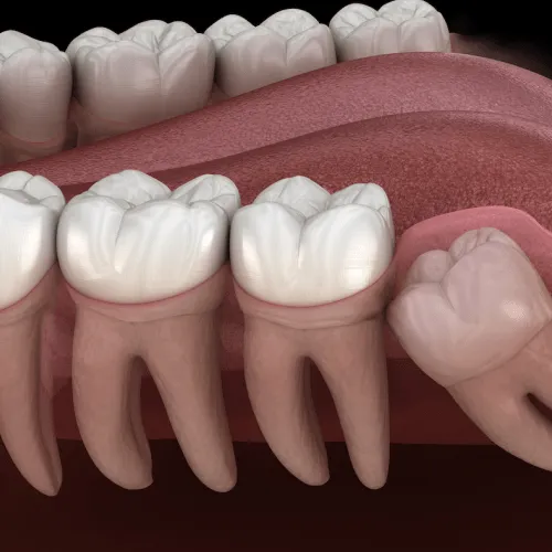 Rendering of an impacted wisdom tooth in the bottom jaw.