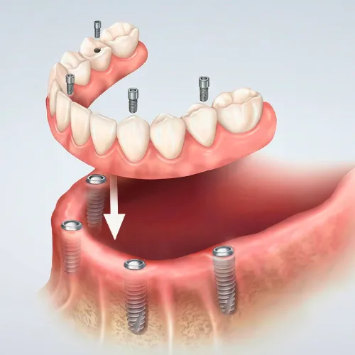 Rendering of a fixed denture being placed onto 4 implants in a lower jaw.