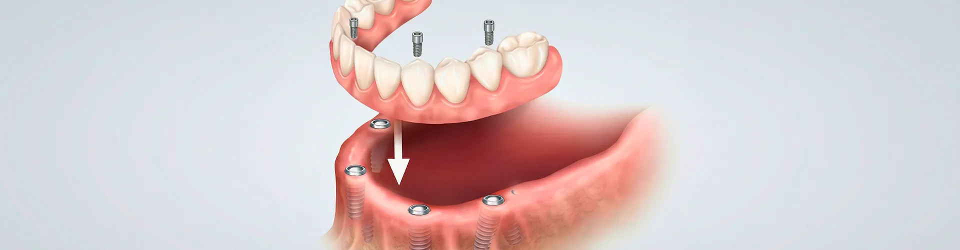 Rendering of a fixed denture being placed onto 4 implants in a lower jaw.