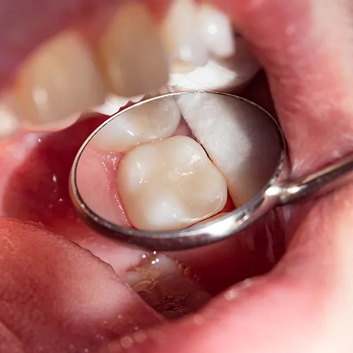 tooth with a filling being reflected in a dental mirror
