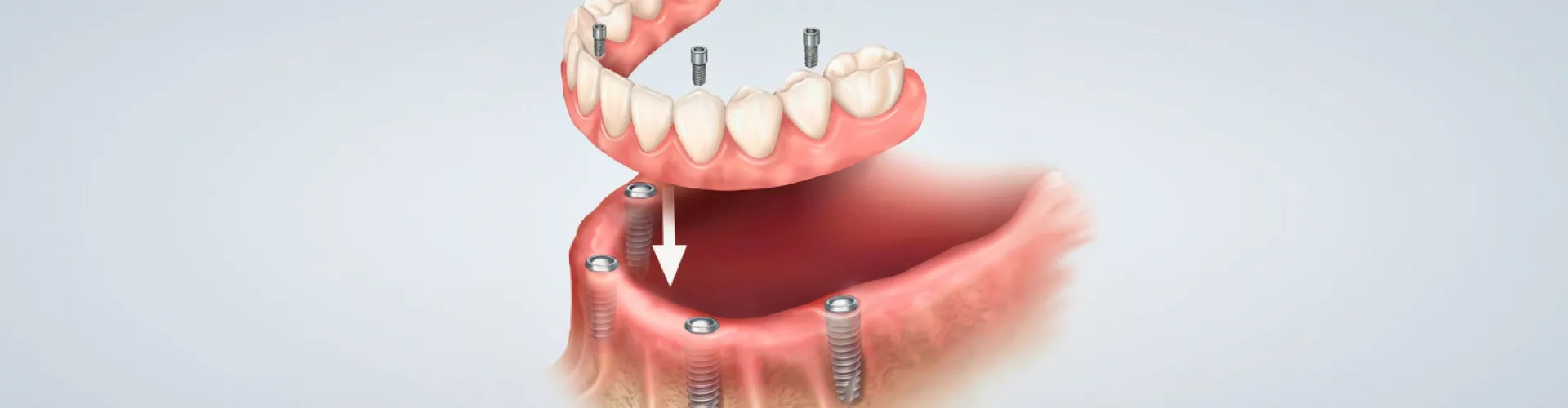 Rendering of a fixed denture being placed onto 4 implants in a lower jaw.