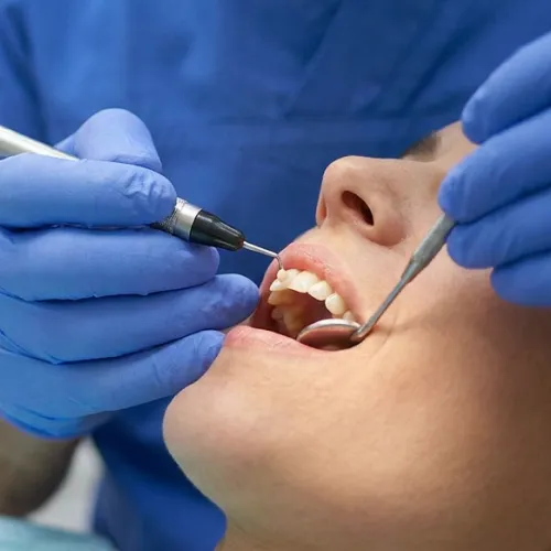 Dentist performing cosmetic dental bonding to close a gap between a patient's front teeth.