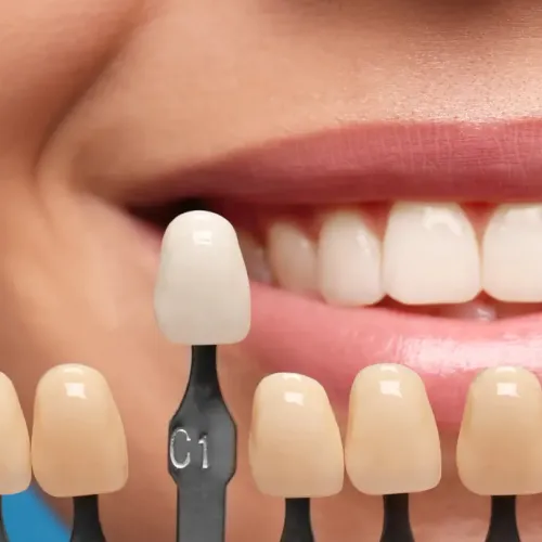 Tooth shade-matching tool in front of woman's smile.