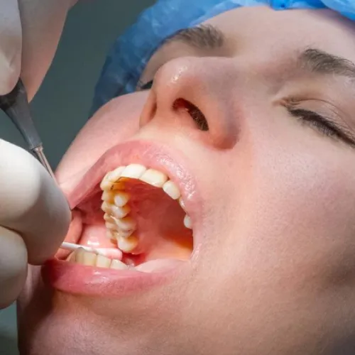 Gloved hands using dental tools in patient's mouth.