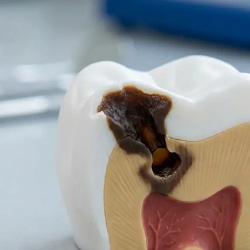 Close-up dental illustration showing a molar with a deep cavity and tooth decay, highlighting cavity treatment and dental fillings at Hillside Dental Care.