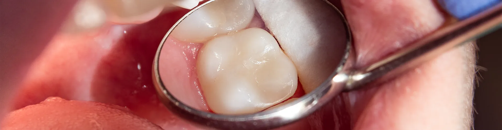 tooth with a filling being reflected in a dental mirror