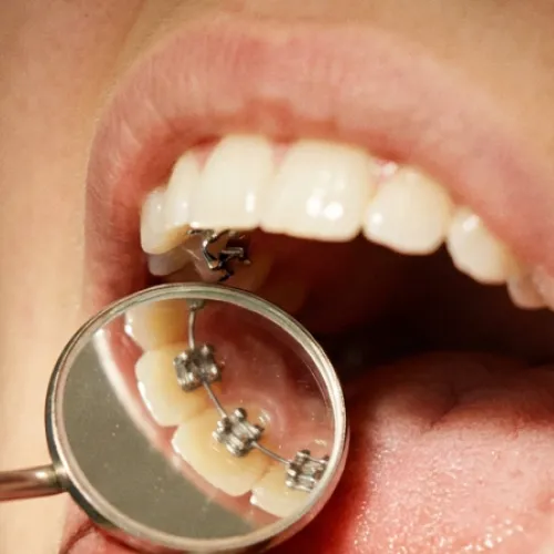 A close-up dental examination showing braces on the back of teeth and a dentist using an intraoral mirror to inspect the patient’s mouth.