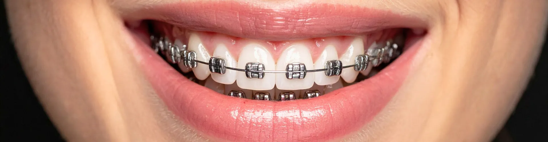 Woman's smile with braces.