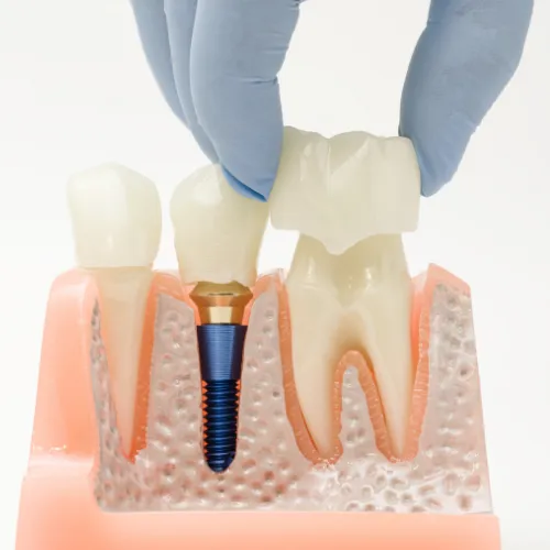 Gloved hand placing dental crown on tooth in model next to dental implant with dental crown.